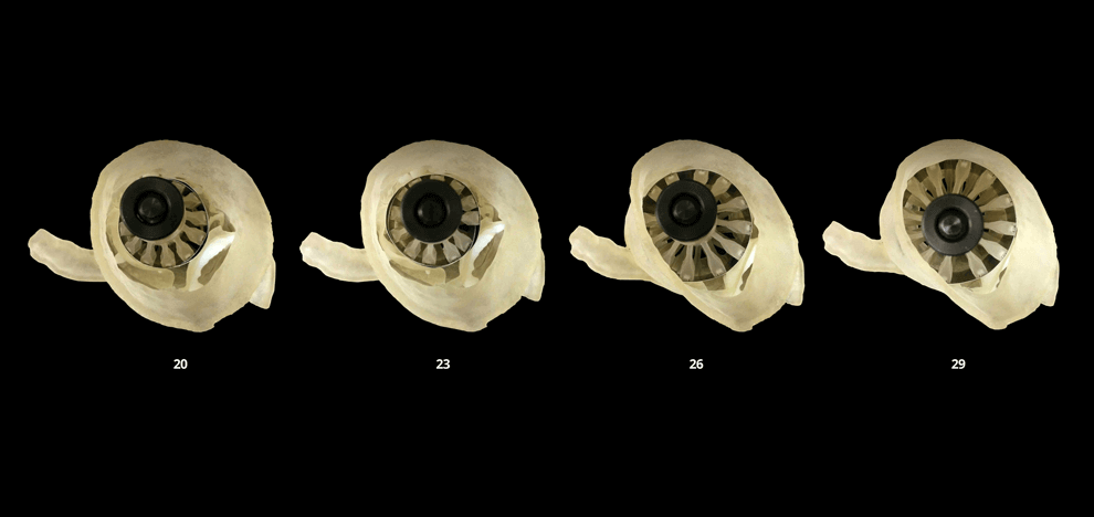 pre-procedural-fit-testing-transcatheter-aortic-valve-replacement-tavr-valves-using-parametric-modeling-3d-printing-8 pre-procedural-fit-testing-transcatheter-aortic-valve-replacement-tavr-valves-using-parametric-modeling-3d-printing-8